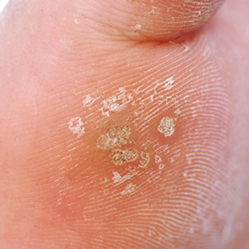 Picture of Plantar Wart on Feet